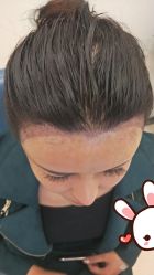 点击看大图 -大麦微针植发丨全国连锁