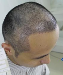 -大麦微针植发丨全国连锁