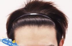 -大麦微针植发丨全国连锁