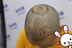 点击看大图 -大麦微针植发丨全国连锁