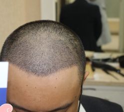 -大麦微针植发丨全国连锁