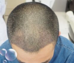 -大麦微针植发丨全国连锁