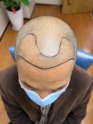 -大麦微针植发全国连锁