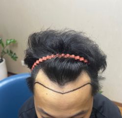 -大麦微针植发全国连锁