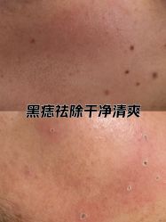 -清疣美疣·痣·斑净肤中心