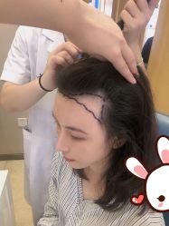 -大麦微针植发丨全国连锁