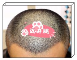 -大麦微针植发全国连锁