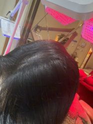 -碧莲盛·不剃发植发