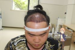 -大麦微针植发丨全国连锁