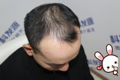 -大麦微针植发丨全国连锁