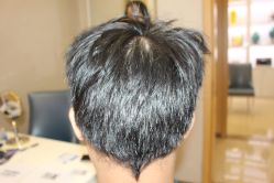 -大麦微针植发丨全国连锁