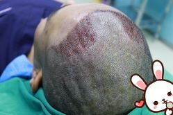 -大麦微针植发丨全国连锁