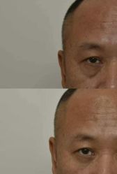 -广州健丽·去眼袋医疗美容机构