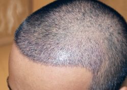 -大麦微针植发丨全国连锁