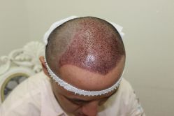 点击看大图 -大麦微针植发丨全国连锁