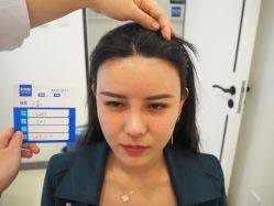 -大麦微针植发丨全国连锁