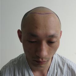 -碧莲盛·不剃发植发