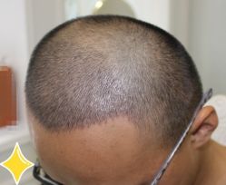 -大麦微针植发丨全国连锁