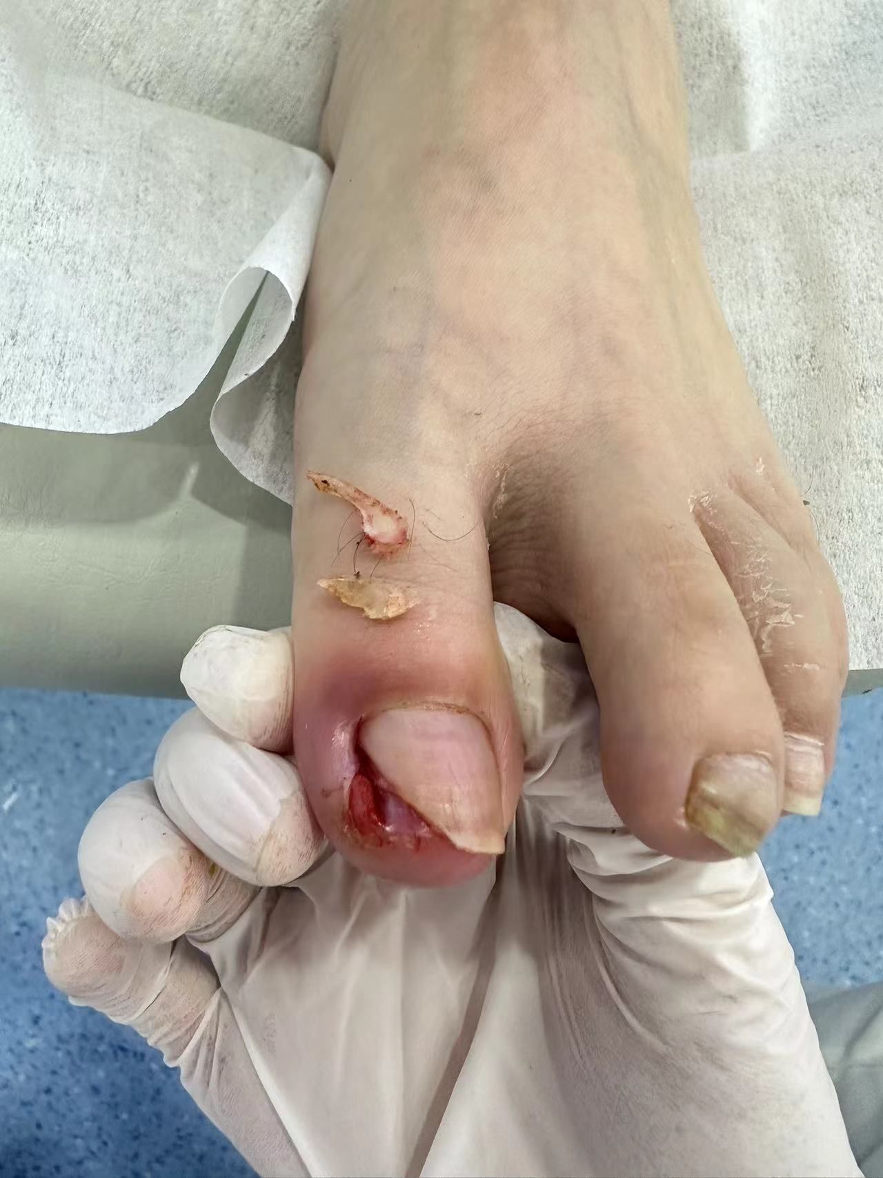 甲沟炎真的很痛耶