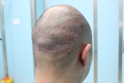 点击看大图 -大麦微针植发丨全国连锁