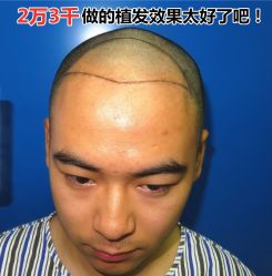 -碧莲盛·不剃发植发