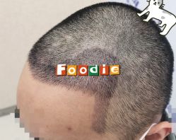 -大麦微针植发全国连锁