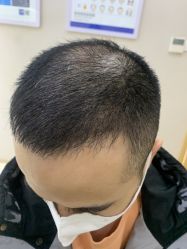 点击看大图 体验后-大麦微针植发丨全国连锁