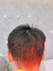 -碧莲盛·不剃发植发