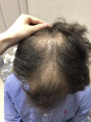 -大麦微针植发丨全国连锁