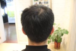 -大麦微针植发丨全国连锁