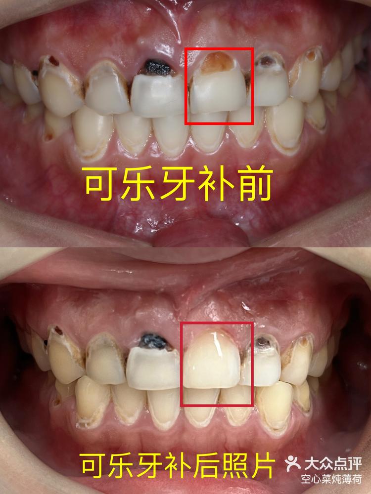 牙釉质缺损图片