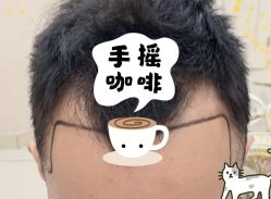 -大麦微针植发全国连锁