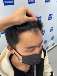 体验后-大麦微针植发全国连锁