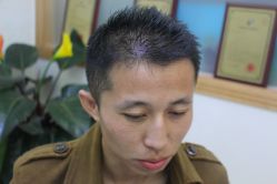 -大麦微针植发丨全国连锁