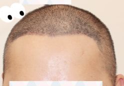 -大麦微针植发全国连锁