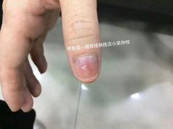 -德哥灰指甲脚气甲沟炎跖疣护理