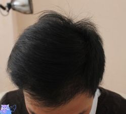 -大麦微针植发丨全国连锁