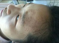 -爱莎扁平疣·汗管瘤·斑痣中心