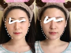 -FACE·日本小颜美容整骨(福田店)