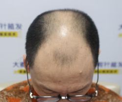 -大麦微针植发丨全国连锁