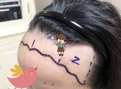 -大麦微针植发全国连锁