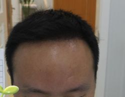 -大麦微针植发丨全国连锁