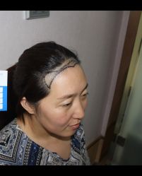 -大麦微针植发全国连锁