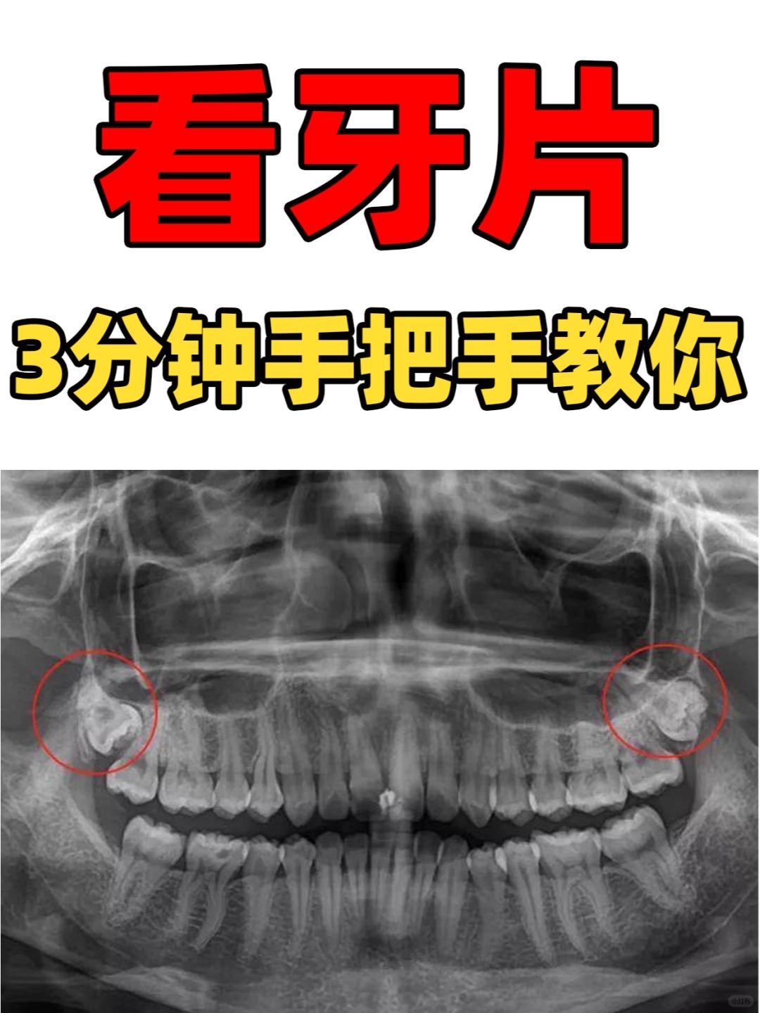 牙齿拍片解析图图片