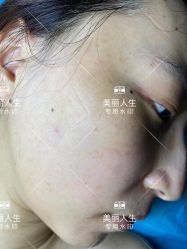 -美丽人生祛斑扁平疣汗管瘤中心