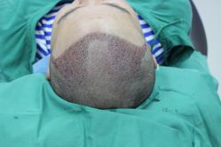 -大麦微针植发丨全国连锁