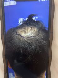 -碧莲盛·不剃发植发