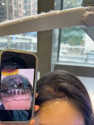 -碧莲盛·不剃发植发