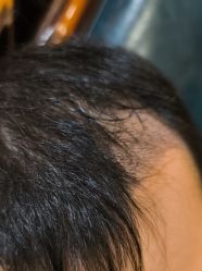 -碧莲盛·不剃发植发