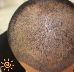 -大麦微针植发丨全国连锁